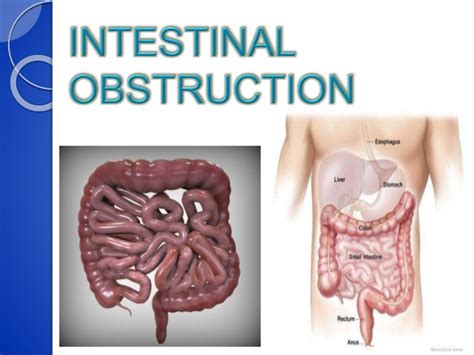 traduction bowel|More.